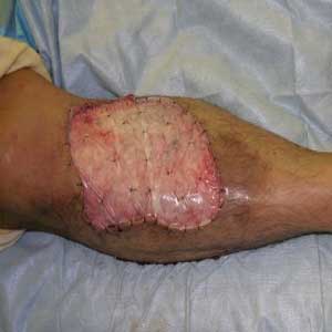 Woud Care IV – Wound Series Part 2 Approaches to Treating Chronic Wounds
